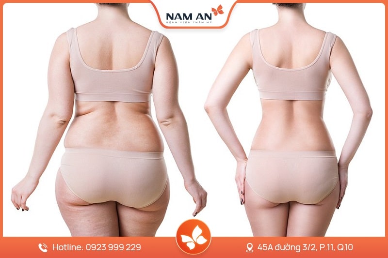 Dịch Vụ Hút Mỡ Toàn Thân An Toàn Tại BVTM Nam An (7)