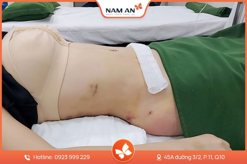 Dịch Vụ Hút Mỡ Toàn Thân An Toàn Tại BVTM Nam An (9)