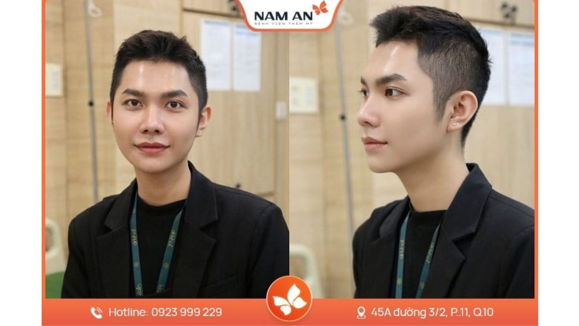 Dịch Vụ Nâng Mũi Nam Giới Chuẩn Lịch Lãm Tại Nam An (1)