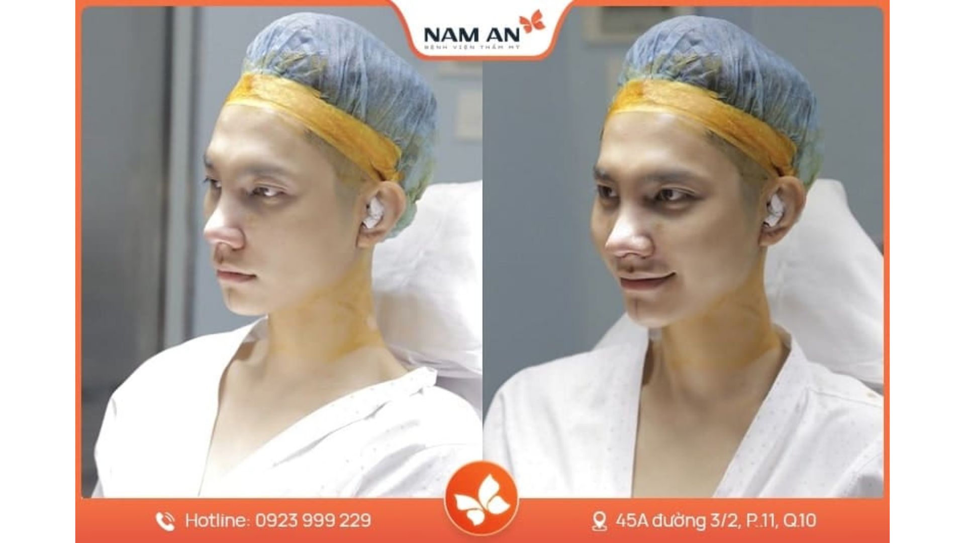 Dịch Vụ Nâng Mũi Nam Giới Chuẩn Lịch Lãm Tại Nam An (4)