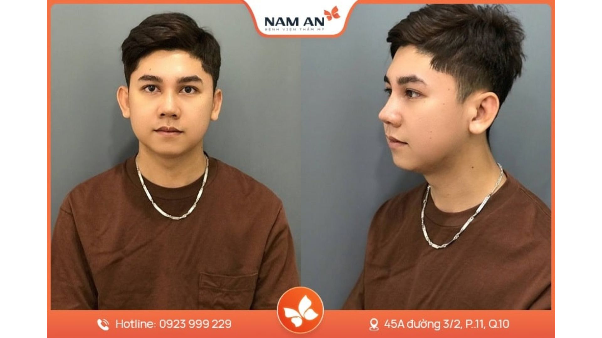 Dịch Vụ Nâng Mũi Nam Giới Chuẩn Lịch Lãm Tại Nam An (5)