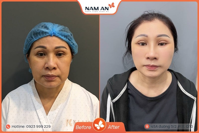 Dịch Vụ Tiêm Filler Thẩm Mỹ An Toàn Tại BVTM Nam An (6)