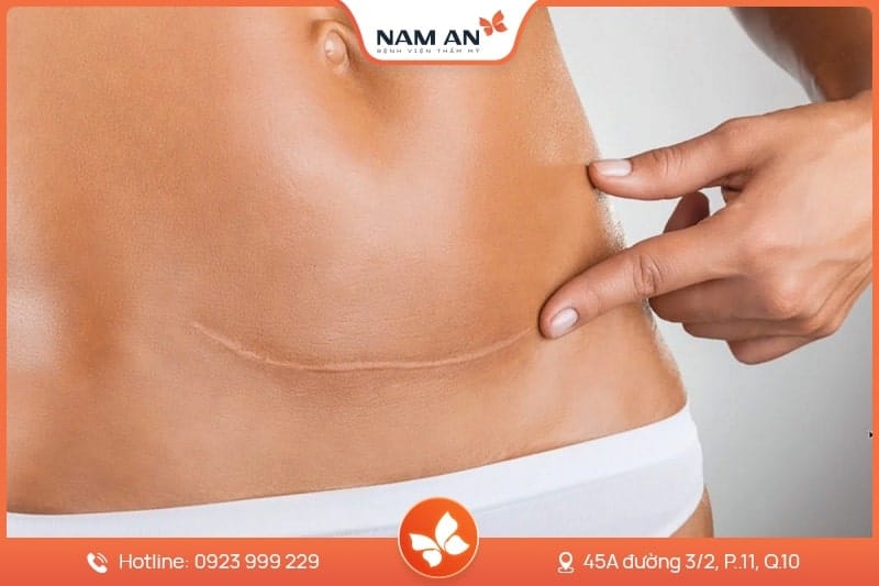 Điều Trị Nám Tận Gốc Bằng Công Nghệ Cao Tại BV Nam An (1)