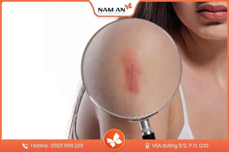 Điều Trị Nám Tận Gốc Bằng Công Nghệ Cao Tại BV Nam An (5)