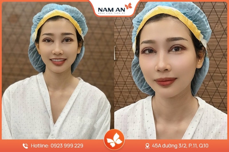 Điều Trị Sụp Mi Mắt Chuẩn Y Khoa Tại BV Thẩm Mỹ Nam An (1)