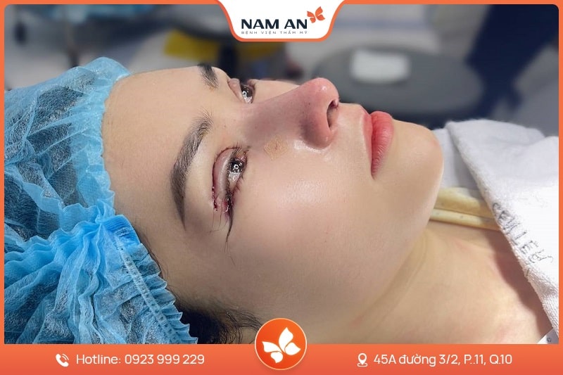 Điều Trị Sụp Mi Mắt Chuẩn Y Khoa Tại BV Thẩm Mỹ Nam An (10)