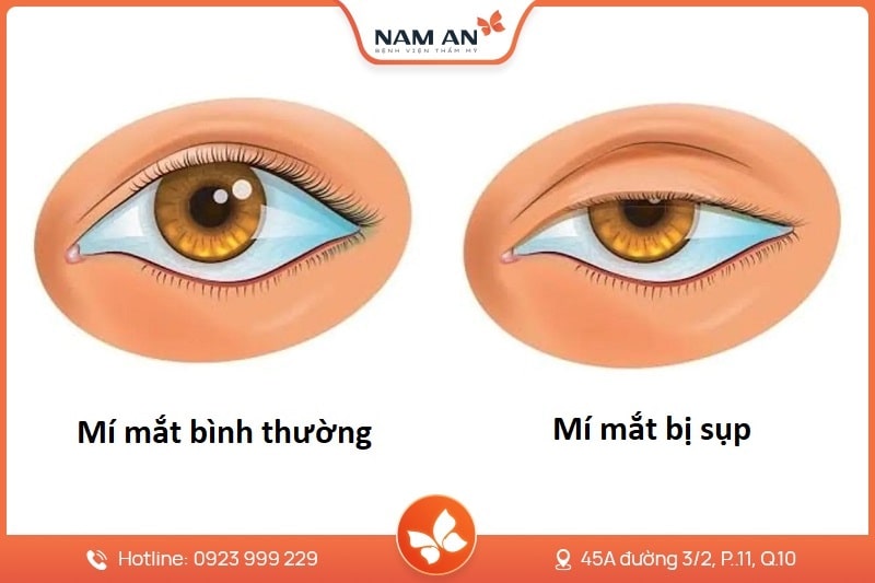 Điều Trị Sụp Mi Mắt Chuẩn Y Khoa Tại BV Thẩm Mỹ Nam An (3)