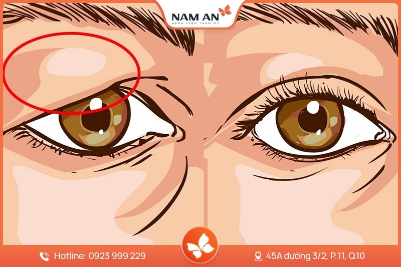 Điều Trị Sụp Mi Mắt Chuẩn Y Khoa Tại BV Thẩm Mỹ Nam An (7)