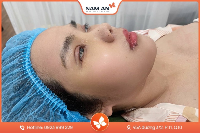 Điều Trị Sụp Mi Mắt Chuẩn Y Khoa Tại BV Thẩm Mỹ Nam An (9)
