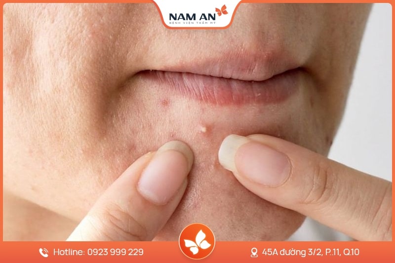 Điều Trị Tàn Nhang Dứt Điểm, Da Sáng Mịn Tại Nam An (1)