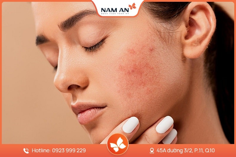 Điều Trị Tàn Nhang Dứt Điểm, Da Sáng Mịn Tại Nam An (10)