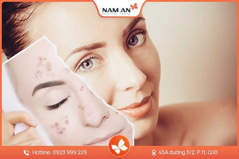 Điều Trị Tàn Nhang Dứt Điểm, Da Sáng Mịn Tại Nam An (2)
