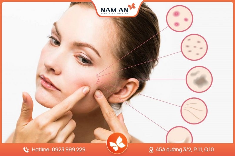Điều Trị Tàn Nhang Dứt Điểm, Da Sáng Mịn Tại Nam An (4)
