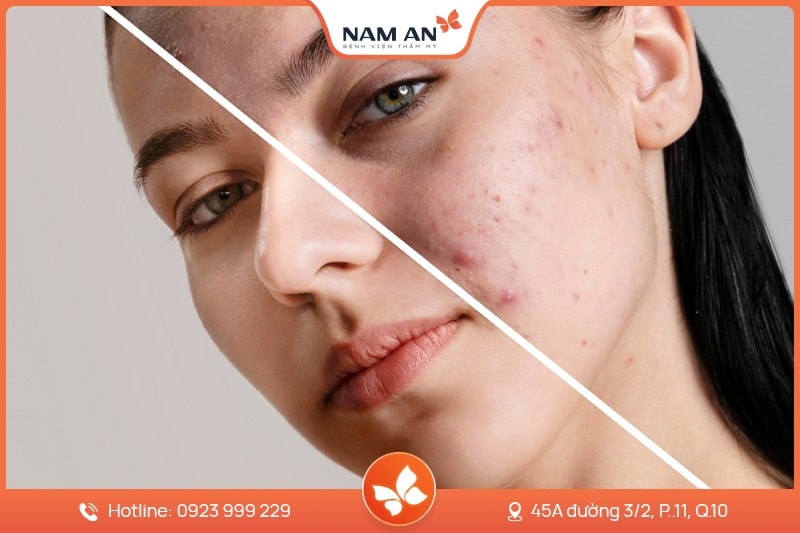 Điều Trị Tàn Nhang Dứt Điểm, Da Sáng Mịn Tại Nam An (9)