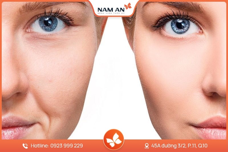 Độn Rãnh Mũi Má - Xóa Nếp Nhăn Trẻ Hóa Tại Nam An (4)