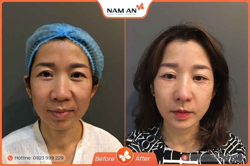 Độn Rãnh Mũi Má - Xóa Nếp Nhăn Trẻ Hóa Tại Nam An (5)