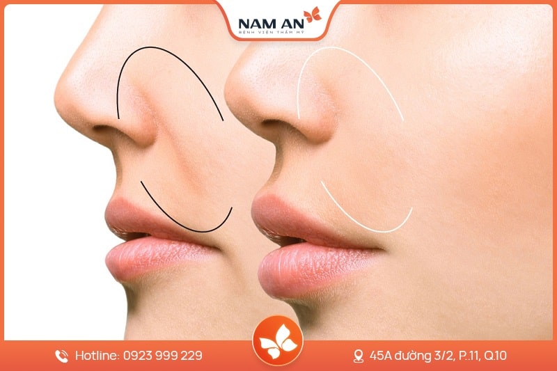 Độn Rãnh Mũi Má - Xóa Nếp Nhăn Trẻ Hóa Tại Nam An (6)