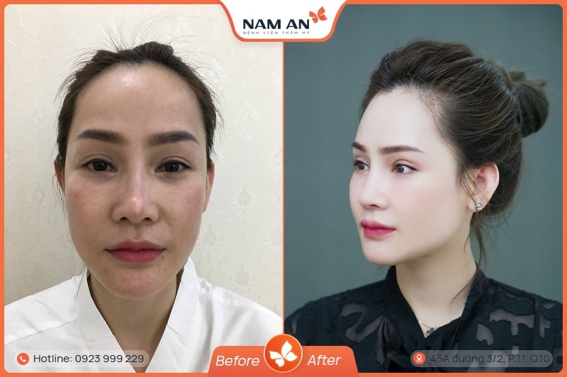 Độn Rãnh Mũi Má - Xóa Nếp Nhăn Trẻ Hóa Tại Nam An (7)