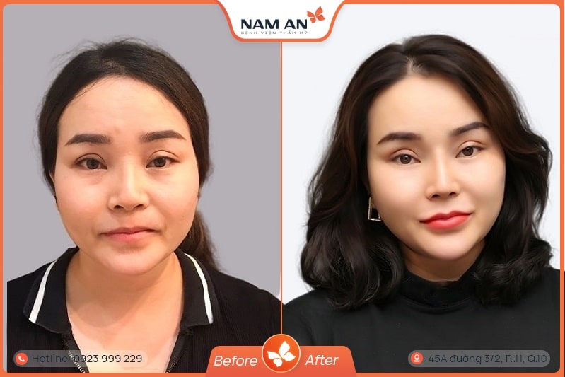 Độn Rãnh Mũi Má - Xóa Nếp Nhăn Trẻ Hóa Tại Nam An