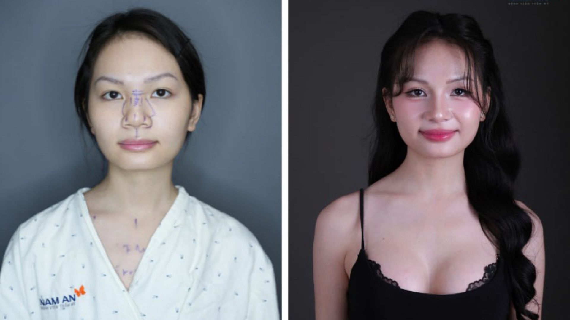 Hành Trình Nâng Mũi Và Vòng 1 Của KOC Thảo Đâyyy (3)