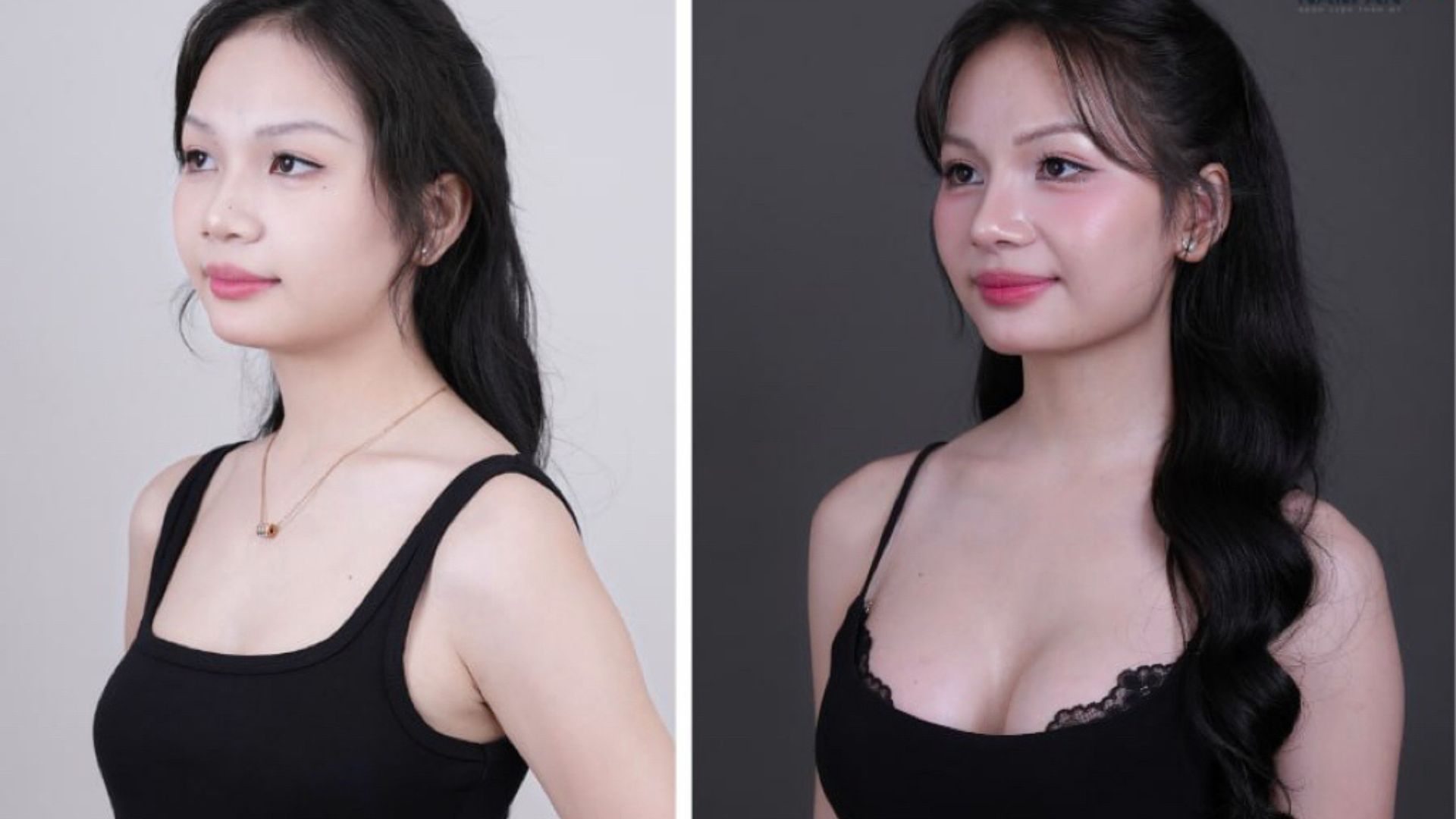Hành Trình Nâng Mũi Và Vòng 1 Của KOC Thảo Đâyyy (5)