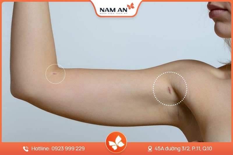 Hút Mỡ Bắp Tay Nhẹ Nhàng, Không Sẹo Tại BVTM Nam An (2)