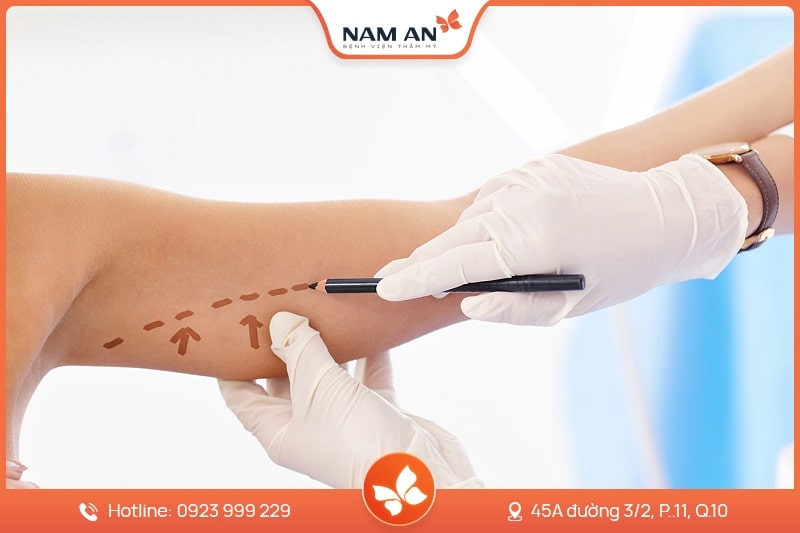Hút Mỡ Bắp Tay Nhẹ Nhàng, Không Sẹo Tại BVTM Nam An (4)