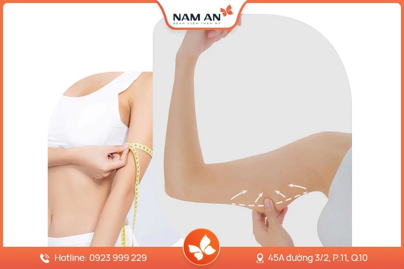 Hút Mỡ Bắp Tay Nhẹ Nhàng, Không Sẹo Tại BVTM Nam An (5)