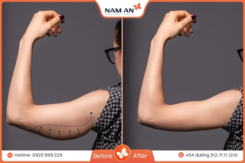Hút Mỡ Bắp Tay Nhẹ Nhàng, Không Sẹo Tại BVTM Nam An (7)