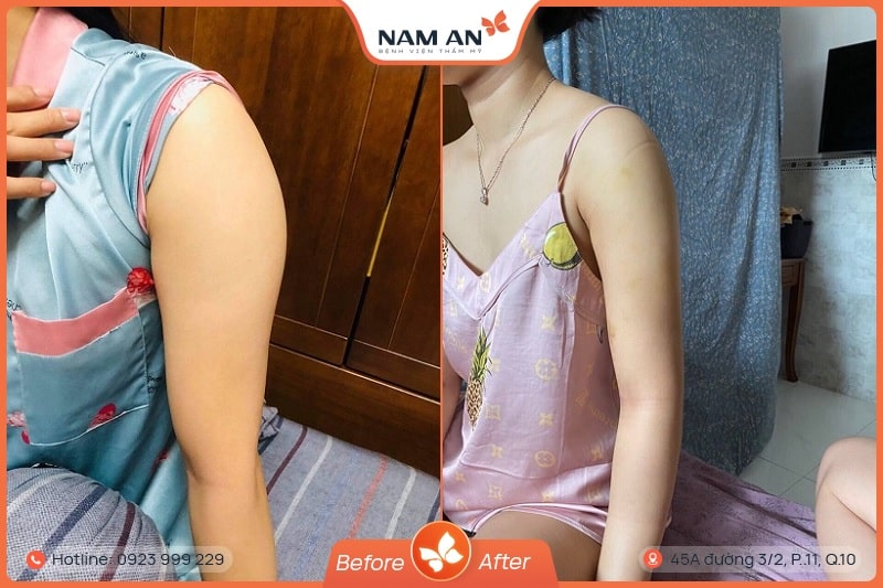 Hút Mỡ Bắp Tay Nhẹ Nhàng, Không Sẹo Tại BVTM Nam An (8)
