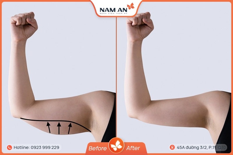Hút Mỡ Bắp Tay Nhẹ Nhàng, Không Sẹo Tại BVTM Nam An
