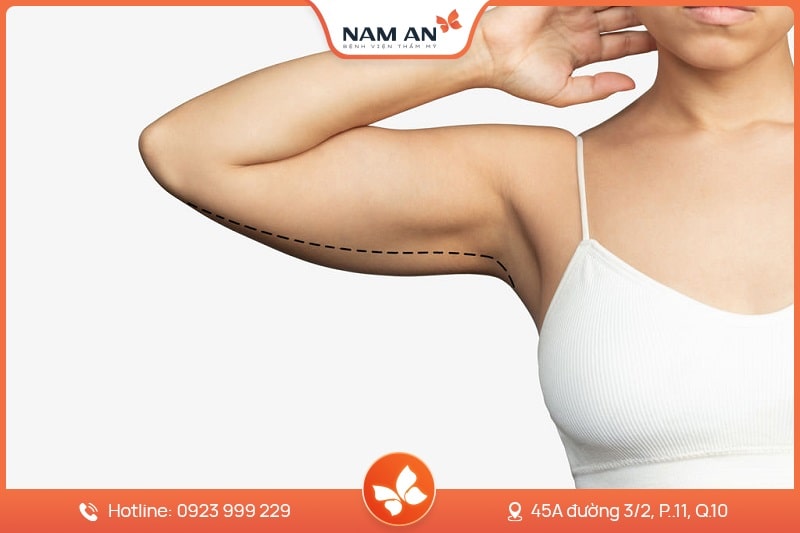 Hút Mỡ Bắp Tay Nhẹ Nhàng, Không Sẹo Tại BVTM Nam An
