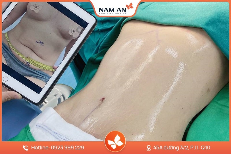 Hút Mỡ Bụng Công Nghệ Laser Lipo - Bệnh Viện Nam An (4)