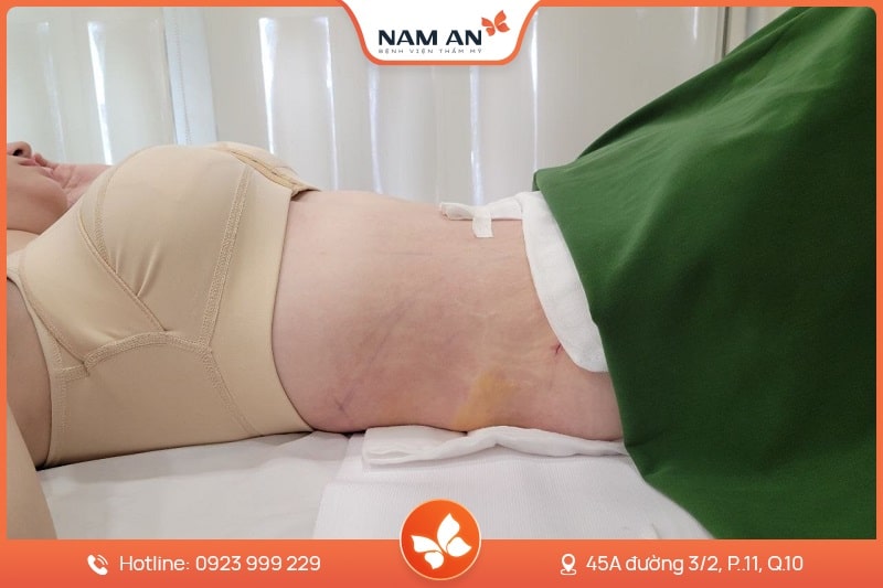 Hút Mỡ Bụng Công Nghệ Laser Lipo - Bệnh Viện Nam An (5)