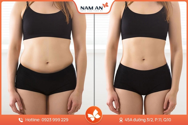 Hút Mỡ Bụng Công Nghệ Laser Lipo - Bệnh Viện Nam An (6)