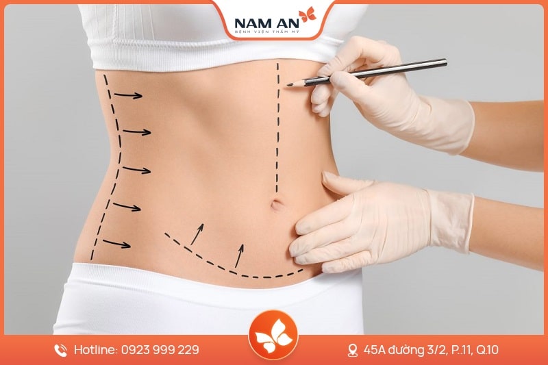 Hút Mỡ Bụng Công Nghệ Laser Lipo - Bệnh Viện Nam An