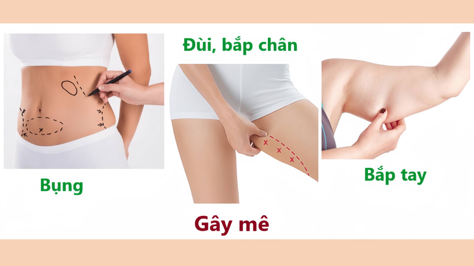 Hút Mỡ Bụng Gây Tê Hay Gây Mê (1)
