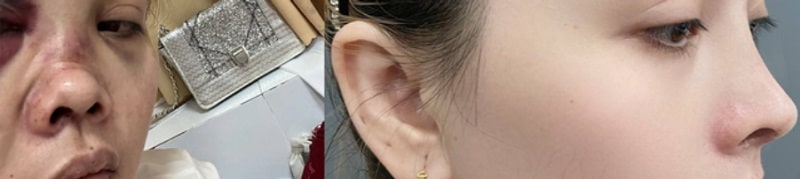 KHỔ SỞ VÌ CHIẾC MŨI BIẾN DẠNG SAU CHẤN THƯƠNG TAI NẠN