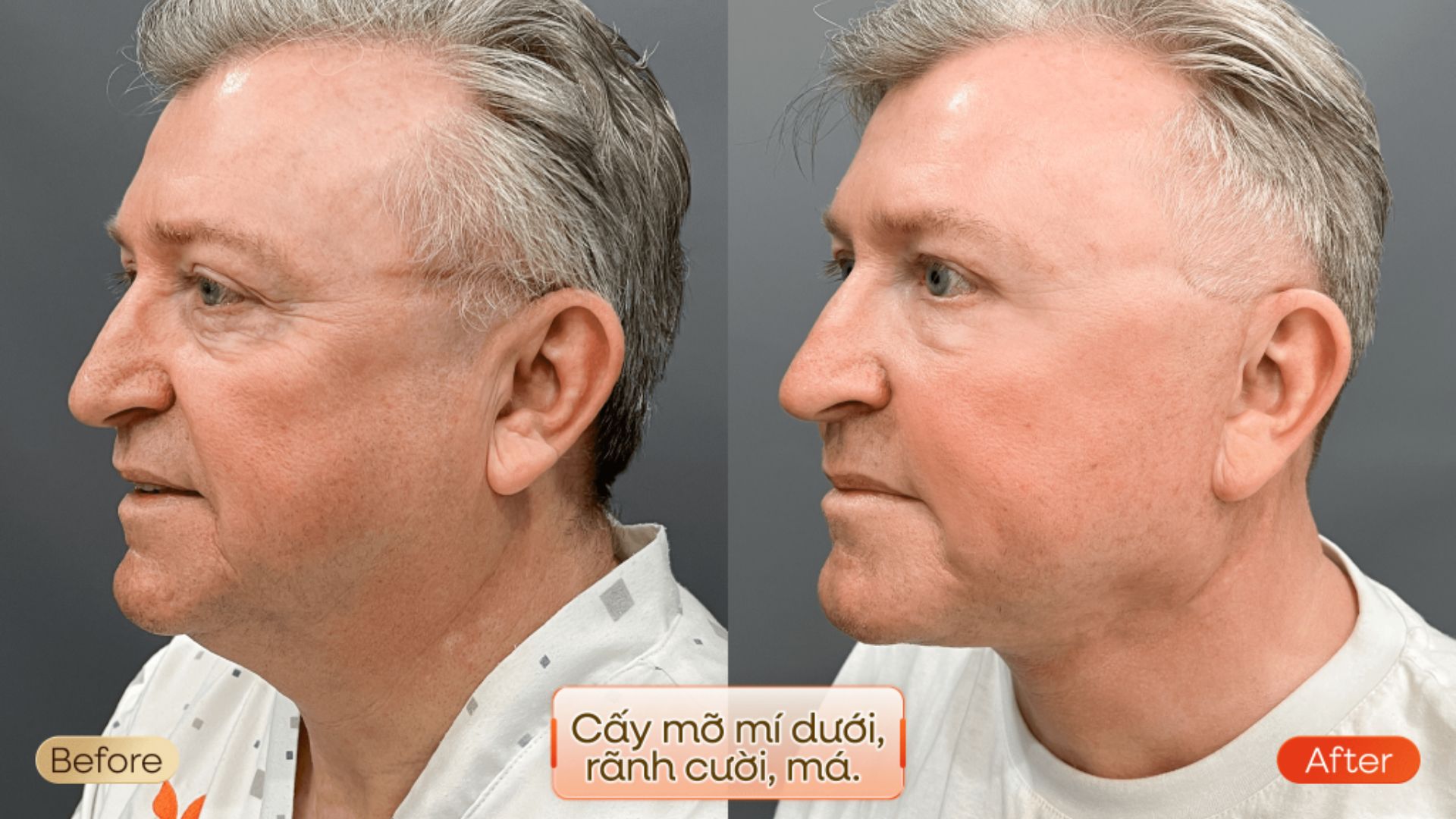 Khách hàng U60 người Đức lấy lại diện mạo trẻ trung sau căng da mặt Deep Plane Facelift kết hợp cấy mỡ tự thân, tự tin cảm nhận mình trẻ hơn 10 tuổi. 