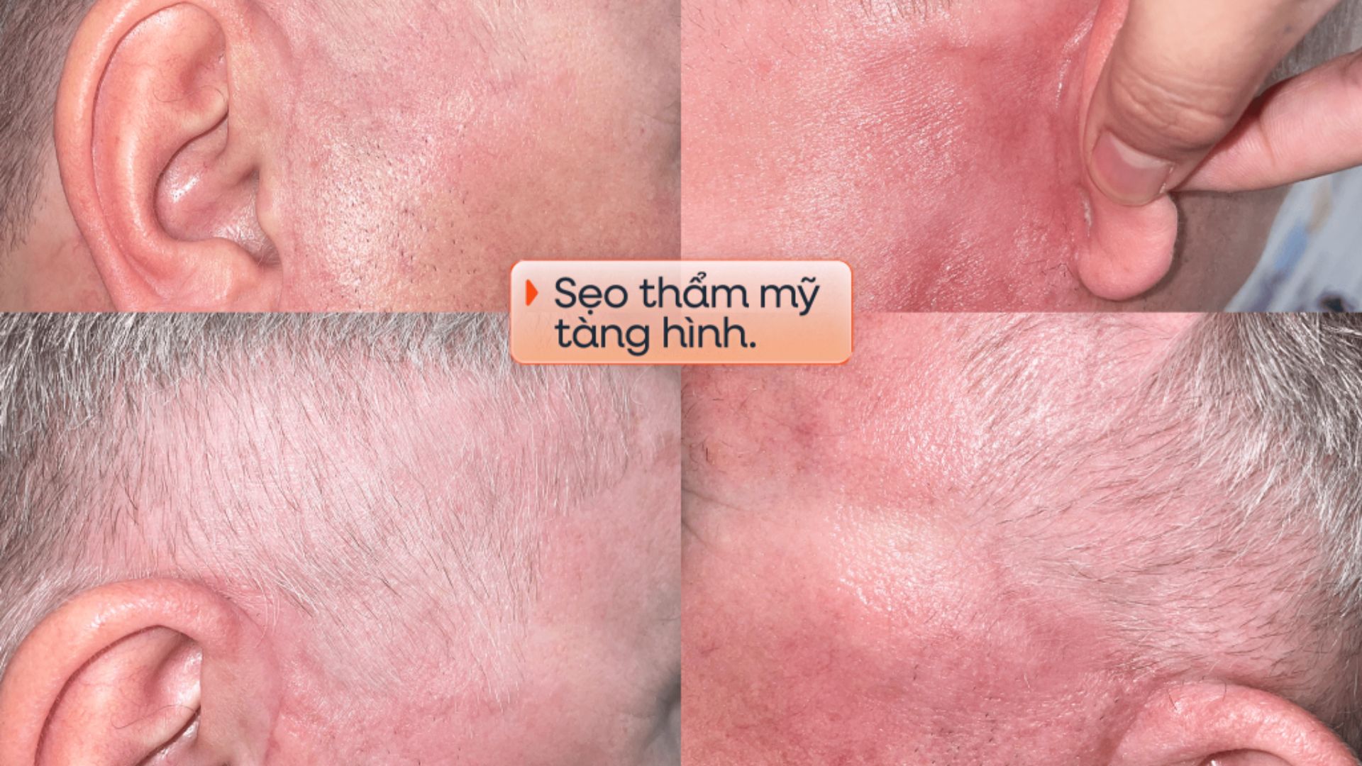 Khách hàng U60 người Đức lấy lại diện mạo trẻ trung sau căng da mặt Deep Plane Facelift kết hợp cấy mỡ tự thân, tự tin cảm nhận mình trẻ hơn 10 tuổi.  (2)