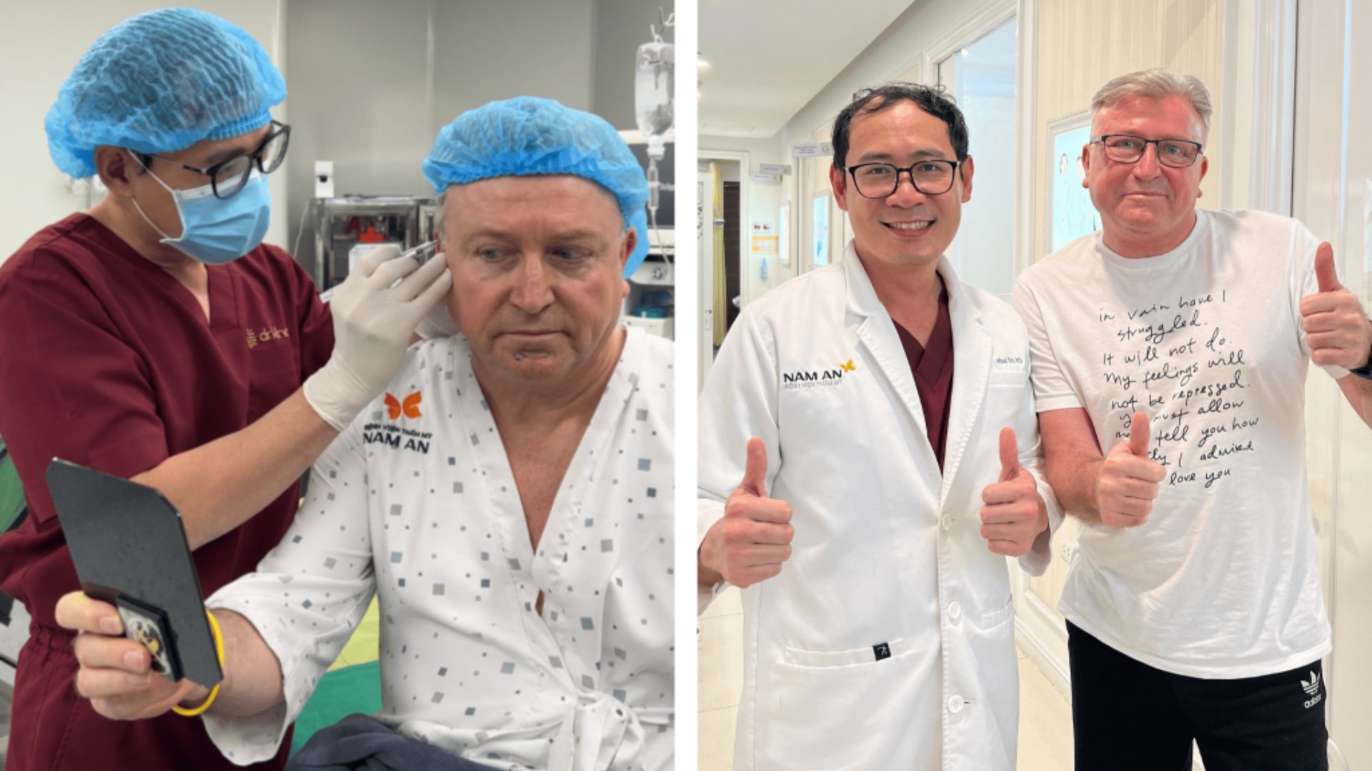 Khách hàng U60 người Đức lấy lại diện mạo trẻ trung sau căng da mặt Deep Plane Facelift kết hợp cấy mỡ tự thân, tự tin cảm nhận mình trẻ hơn 10 tuổi.  (4)