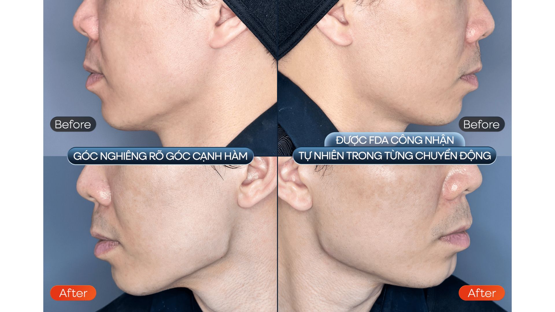 Ký Kết Đối Tác Chiến Lược Giữa Nam An & Teoxane RHA (5)