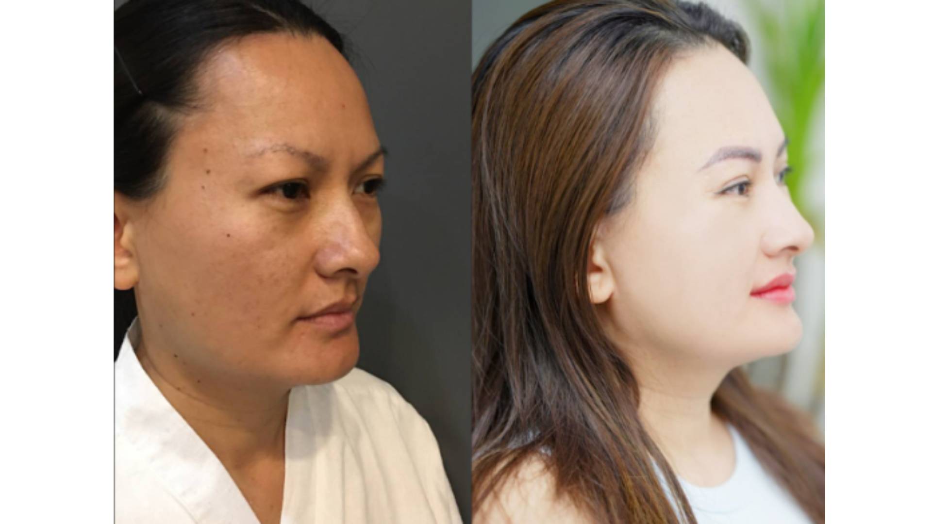 Lưu Ý Quan Trọng Khi Phẫu Thuật Gọt Hàm V-Line (3)