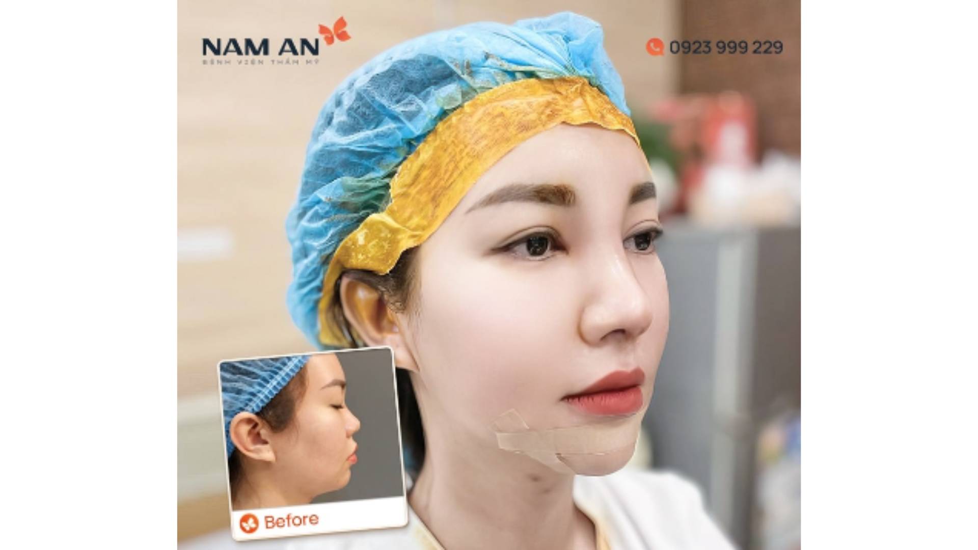 Lưu Ý Quan Trọng Khi Phẫu Thuật Gọt Hàm V-Line (3)
