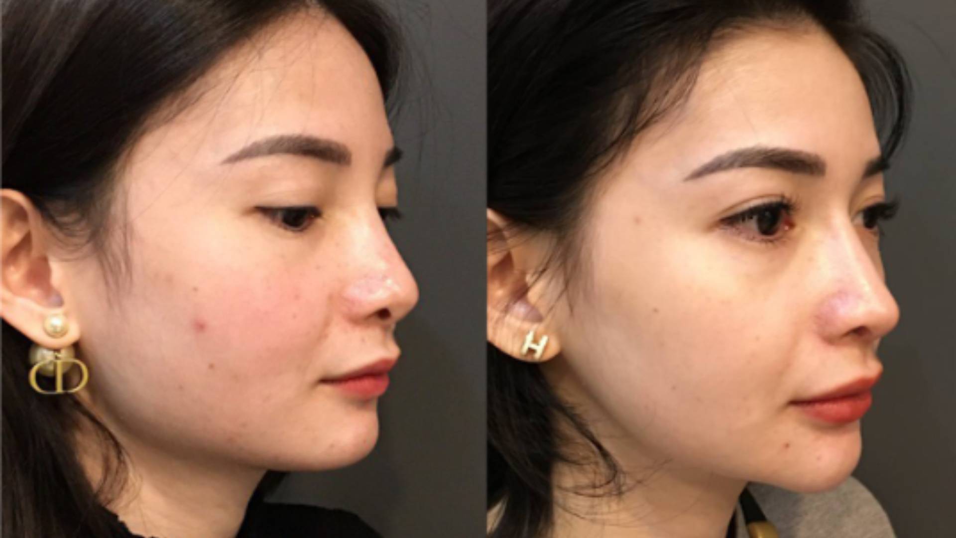 Lưu Ý Quan Trọng Khi Phẫu Thuật Gọt Hàm V-Line (3)