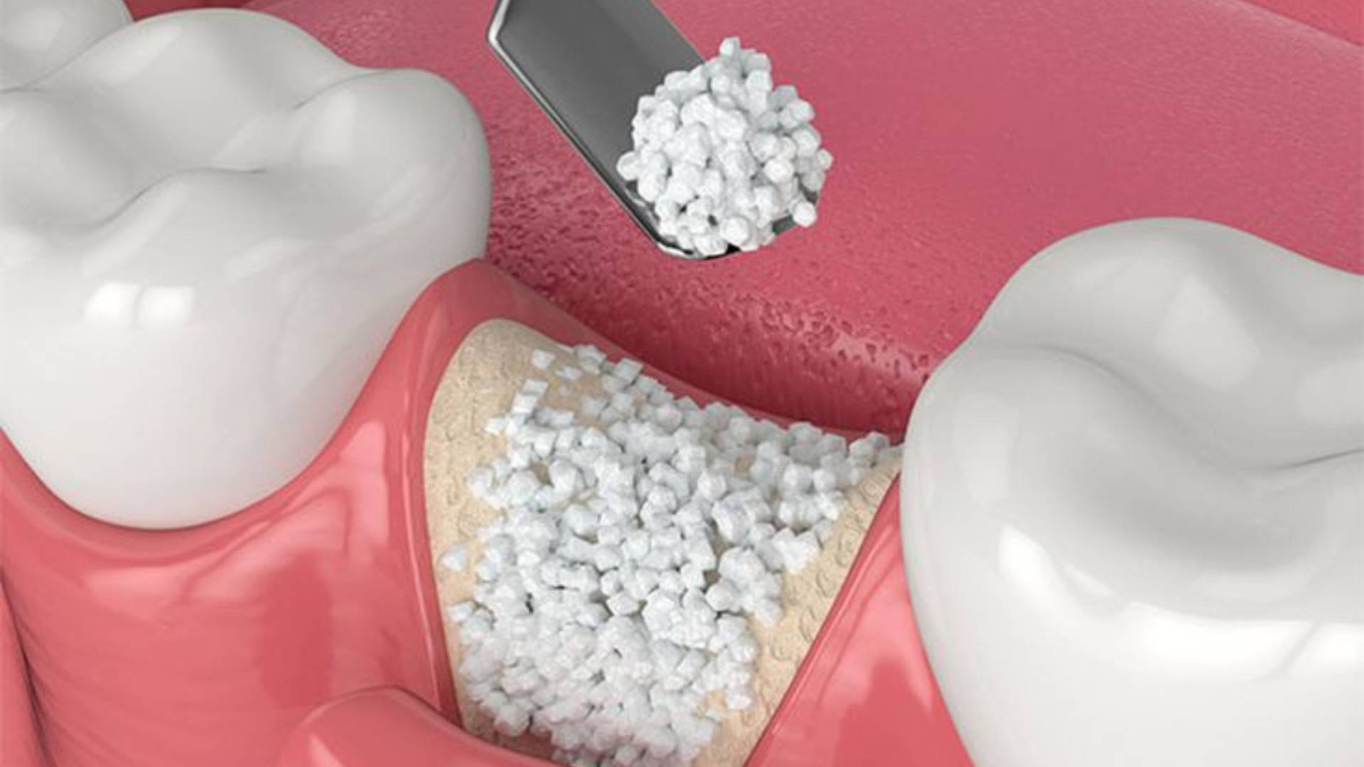 Mất Răng Lâu Năm Cấy Ghép Implant Có Phức Tạp Không (1)