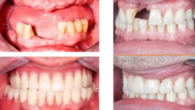 Mất Răng Lâu Năm Cấy Ghép Implant Có Phức Tạp Không?
