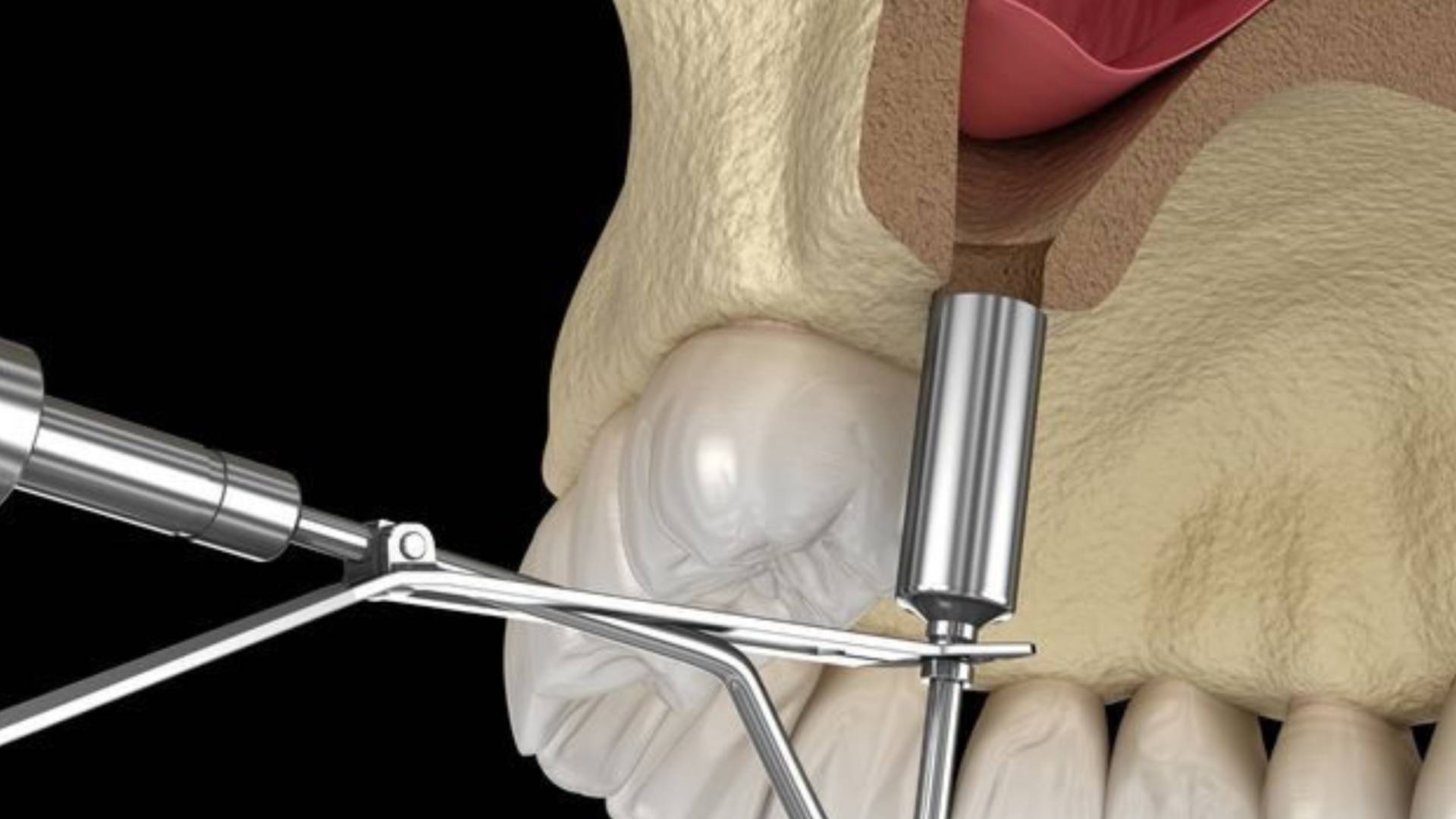 Mất Răng Lâu Năm Cấy Ghép Implant Có Phức Tạp Không (6)