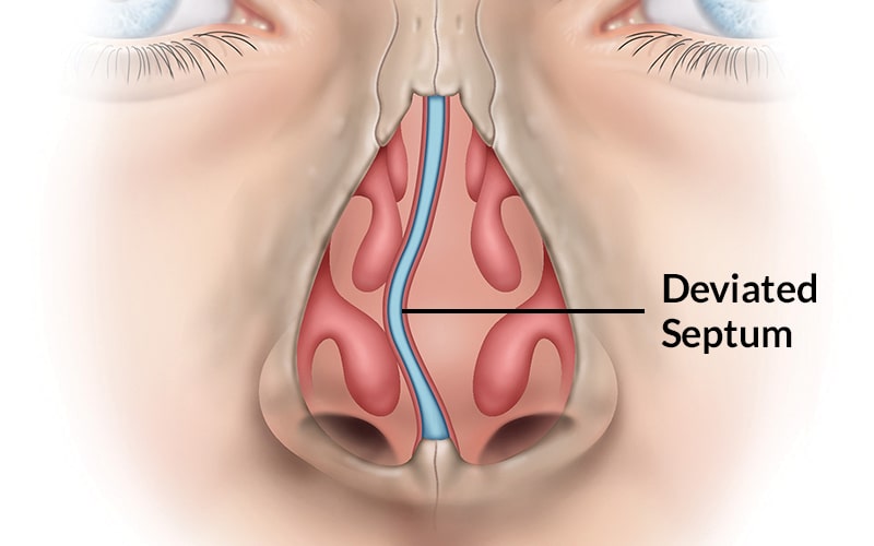 Mũi Bị Hỏng Sau Phẫu Thuật Có Sửa Lại Được Không (2)