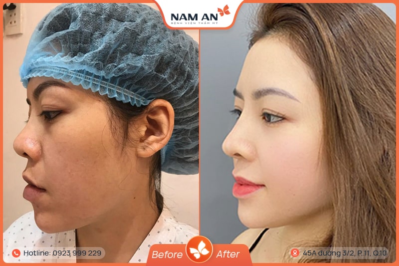 Nâng Mũi Bọc Sụn Tự Nhiên, Ngăn Biến Chứng Tại Nam An (4)